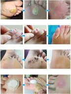 【Apply and peel】Corn remover
